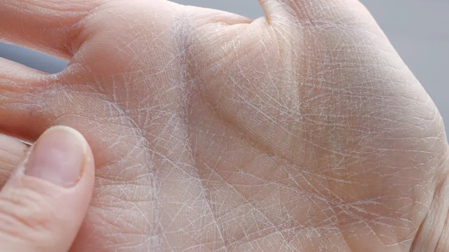 Dry skin