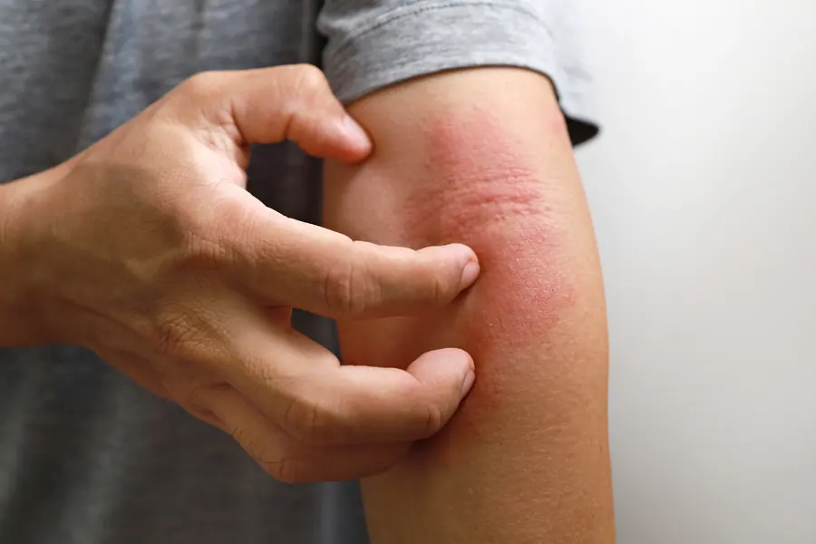 Eczema