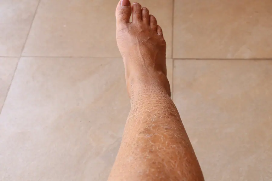 Ichthyosis